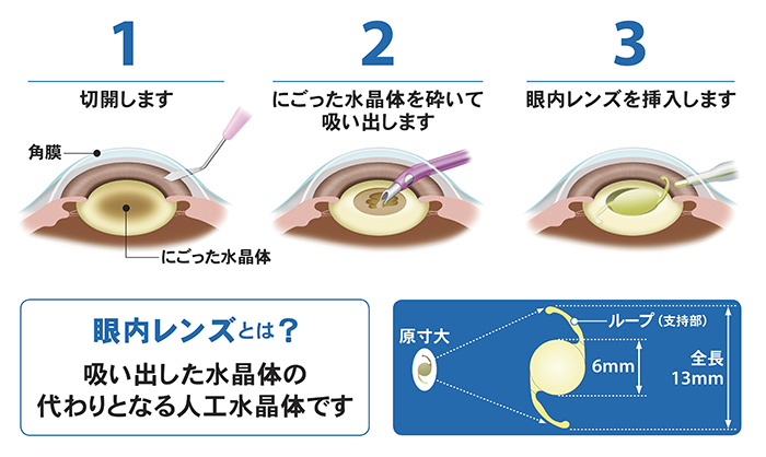 白内障手術の流れ | 菅田眼科クリニック