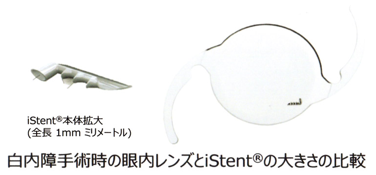 白内障手術時の眼内レンズとiStentの大きさの比較 | 菅田眼科クリニック