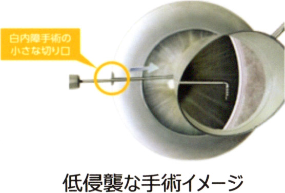 低侵襲な手術イメージ | 菅田眼科クリニック
