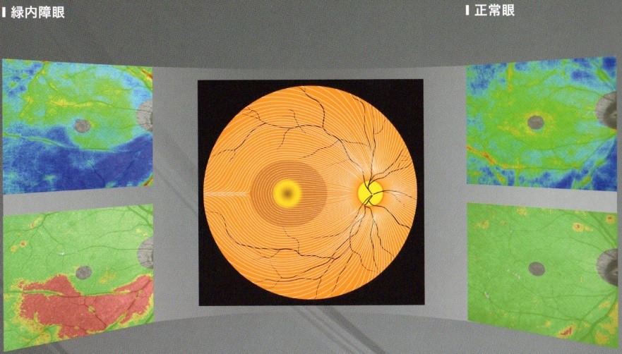 OCTによる網膜の神経線維解析の図 | 菅田眼科クリニック